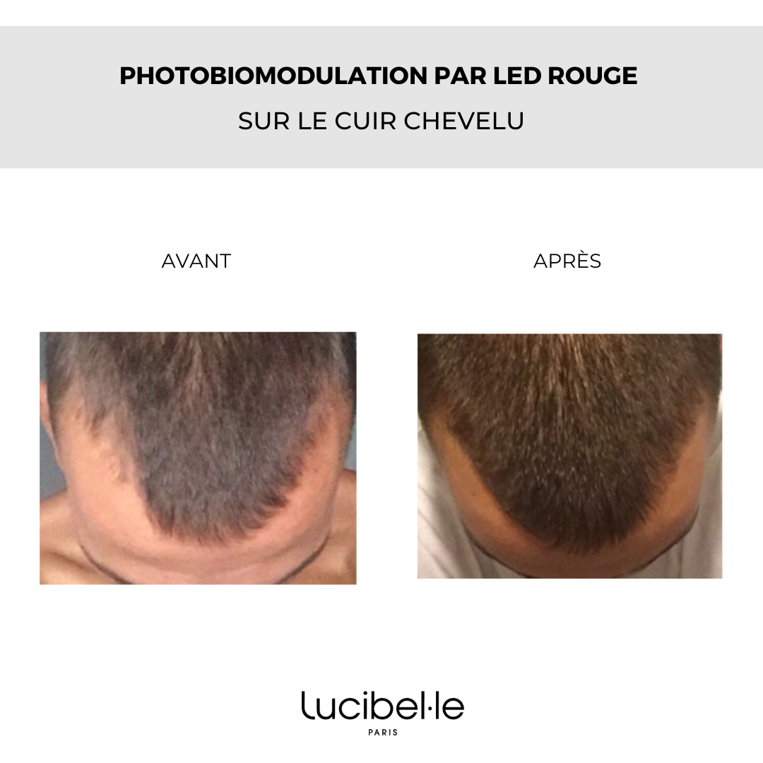 Résultat après 3 à 5 mois du casque LED capillaire Lucibelle Paris
