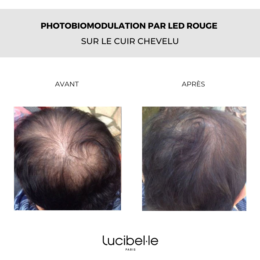 Hair OVE - Casque LED capillaire – Image 8