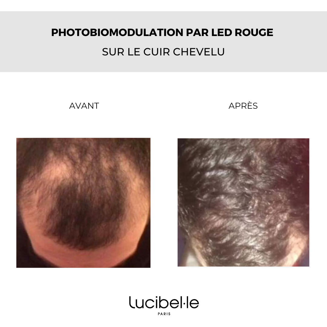 Hair OVE - Casque LED capillaire – Image 7